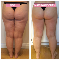 Anti-Cellulite-Cupping-Gerät – SlimCupp